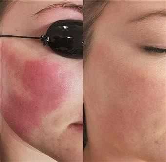 Before and after photos showing laser treatment reducing facial redness.